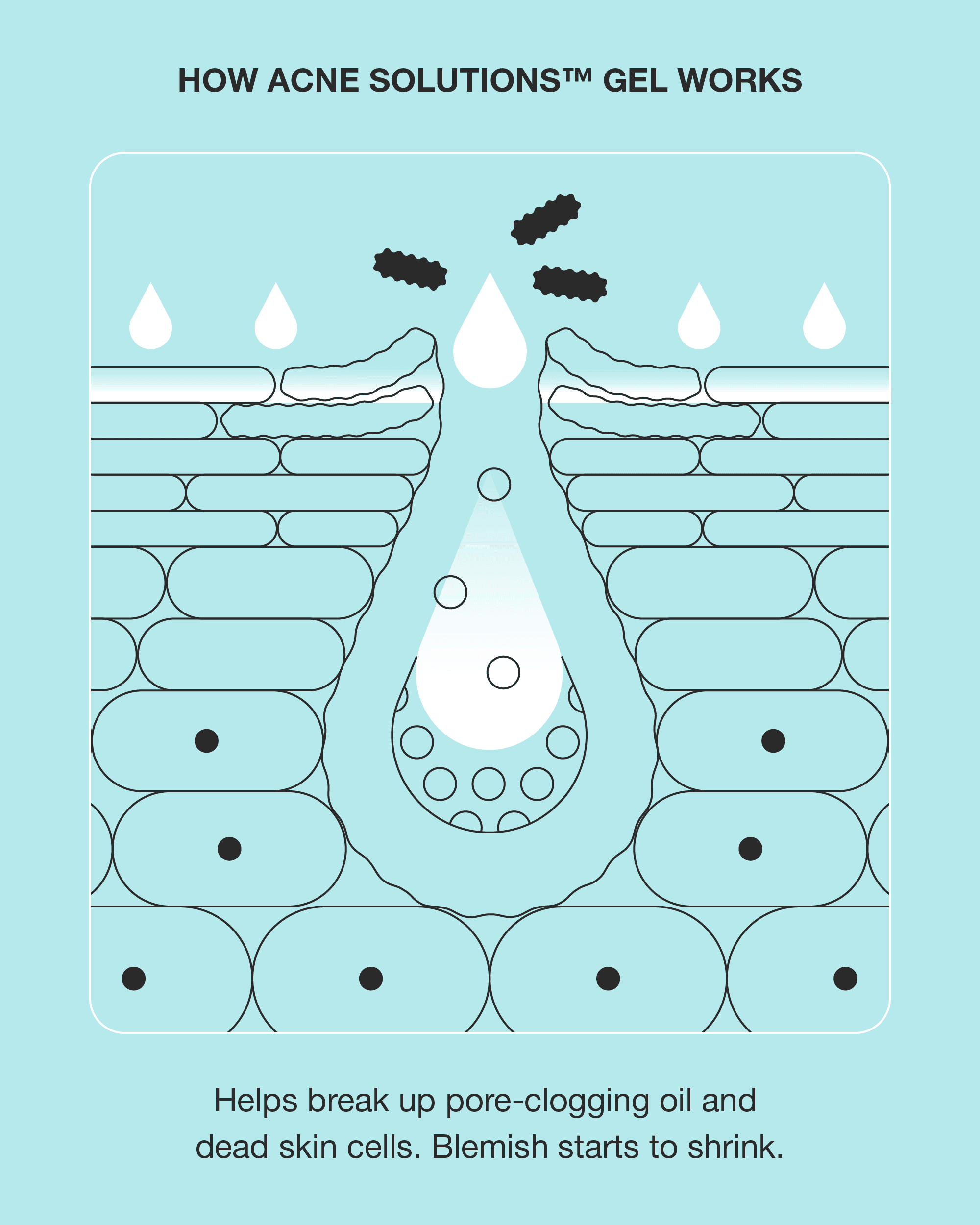 Clinique Acne Solutions diagram showing oil and dead skin cells leaving a pore